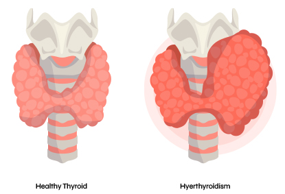 Thyroid Cancer: Causes, Symptoms, Complications, And All You Should Know